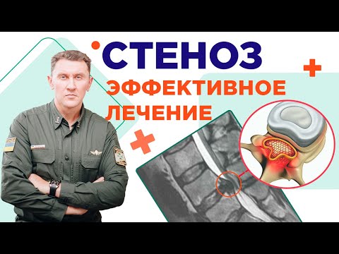 Видео: Как правильно лечить стеноз! Нейрохирург Александр Печиборщ