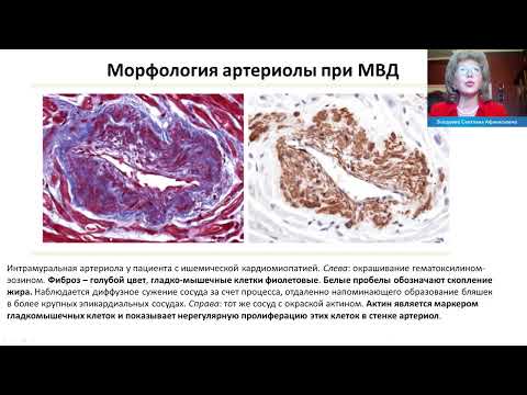 Видео: Микроваскулярная дисфункция при острых и хронических формах ИБС: клиническое значение