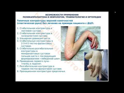 Видео: allianceortho ru АльянсОрто 20190417 Клиническое ортезирование пациентов с ДЦП, спастическими и вялы