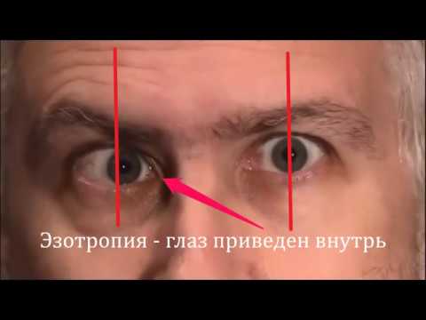 Видео: Глазодвижения. Лекция №4: Парез VI нерва