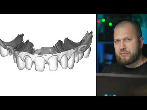 Видео: Разбор работы для стоматологов. Обточка зубов. Препарирование. Планирование улыбки. Виниры и мокап