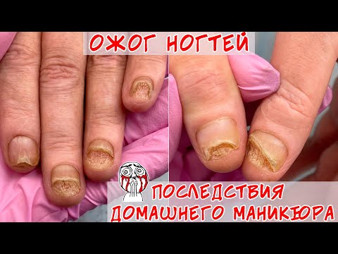 Видео: Ожог ногтевой пластины / Отрывала гель лак вместе с ногтем