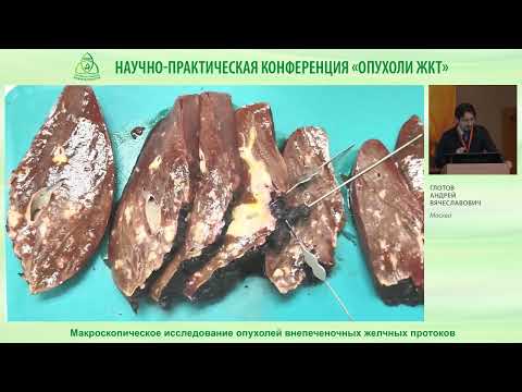 Видео: Макроскопическое исследование опухолей внепеченочных желчных протоков