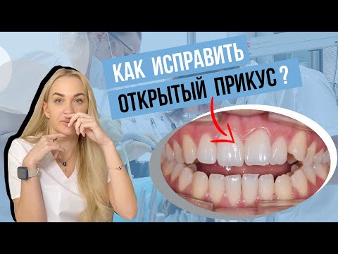 Видео: Открытый прикус. Причины, последствия и лечение.