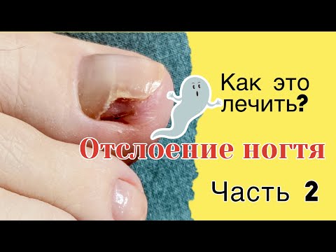 Видео: Онихолизис: профилактика, домашний уход (Часть 2)