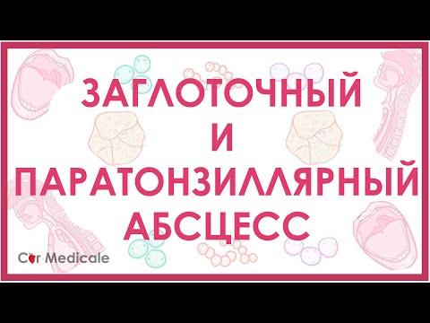 Видео: Заглоточный и паратонзиллярный абсцессы - что такое, причины, осложнения