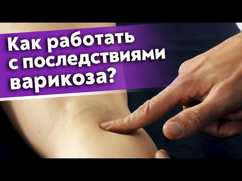 Видео: Как избавиться от варикоза? / Лечение варикоза массажем