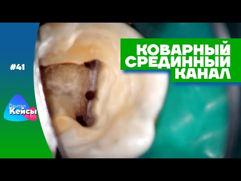 Видео: Коварный срединный канал | Дентал Кейсы от BG #41