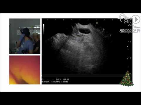 Видео: ЭУС трансляция