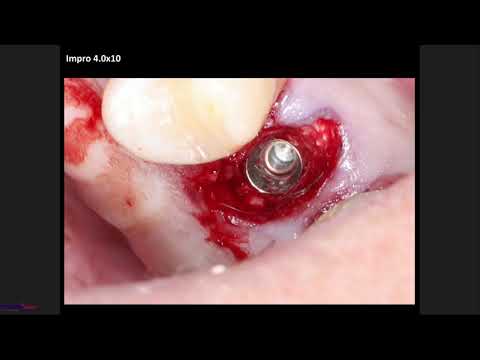 Видео: "Панцулая В.Г. Одномоментная имплантация и немедленная нагрузка"(18.06.2019)