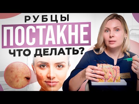Видео: Как убрать шрамы и рубцы с помощью субцизии? ТОП метод по избавлению от шрамов.