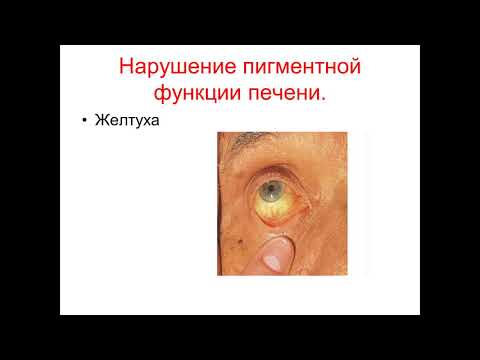 Видео: 1.Синдром портальной гипертензии. 2.Синдром печеночно-клеточной недостаточности
