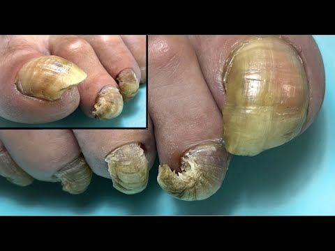 Видео: Рог-вместо ногтя🤯/ Онихогрифоз (птичий коготь). Сложный педикюр