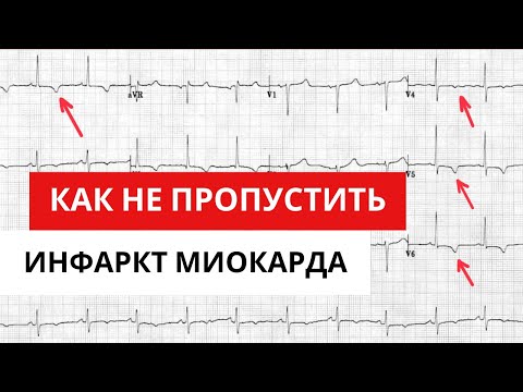 Видео: Как не пропустить инфаркт миокарда. Сложности анализа ЭКГ.