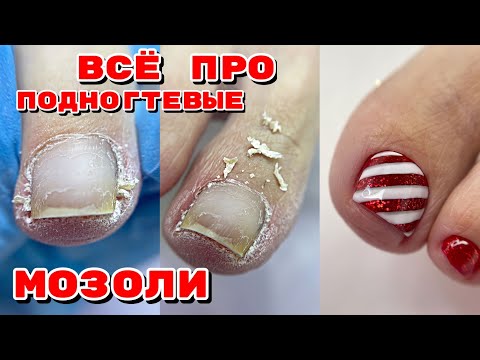 Видео: ВСЕ про ПОДНОГТЕВЫЕ МОЗОЛИ 🦶 Педикюр 🦶 Дизайн ногтей на ногах