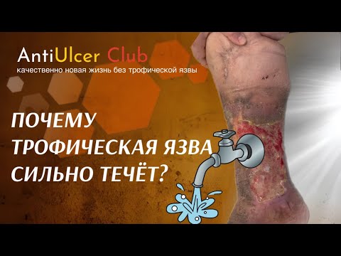 Видео: Сильно течёт трофическая язва. Что делать и как это остановить?