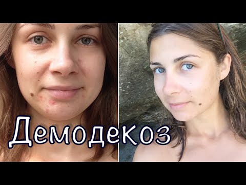 Видео: ДЕМОДЕКОЗ - ЛЕЧЕНИЕ мой опыт, косметика Demodex-Complex