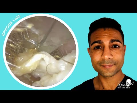 Видео: 1433 — Удаление массивного кратера на дне слухового прохода, заполненного омертвевшей кожей, с по...