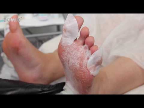 Видео: Аппаратный педикюр с применением Пенного экспресс-размягчителя "Жидкое лезвие"