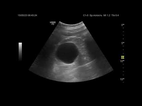Видео: Ультразвуковая диагностика (УЗИ). Доктор Иогансен. Видеопримеры. Выпуск 17. Кисты почек.
