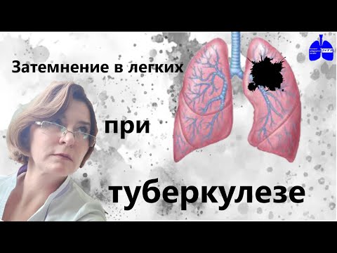 Видео: Затемнение в легких при туберкулезе