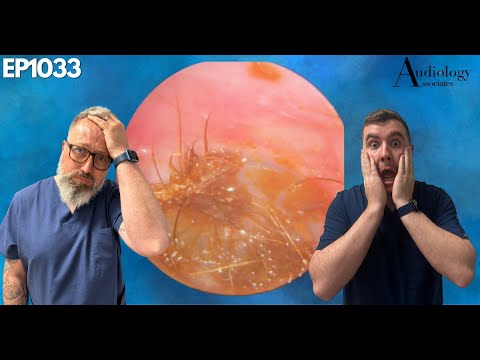 Видео: Удаление сложных ушных серных пробок с помощью аспирации и промывания — EP1033