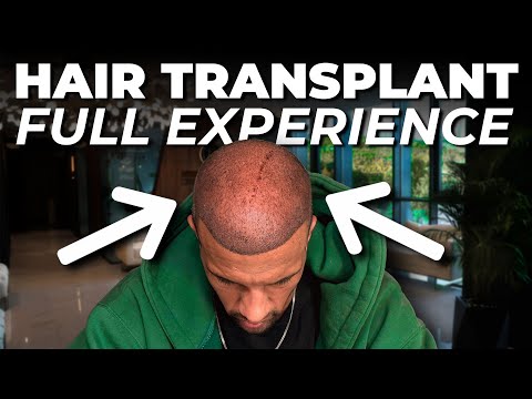 Видео: Пересадка волос в Турции: как это выглядит на самом деле — Now Hairtime