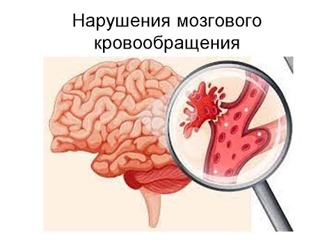 Видео: Нарушения мозгового кровообращения
