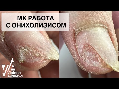 Видео: ОНИХОЛИЗИС. МАНИКЮР. Виктория Авдеева