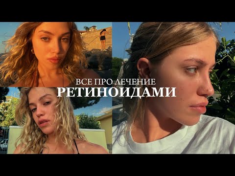 Видео: РЕТИНОИДЫ. РОАККУТАН. История лечения