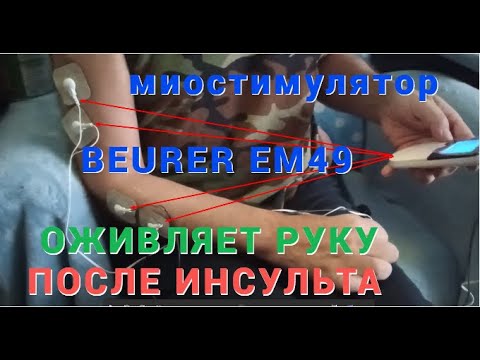 Видео: ОЖИВЛЯЕМ ПАРАЛИЗОВАННУЮ РУКУ ПРИ ПОМОЩИ МИОСТИМУЛЯТОРА!!!