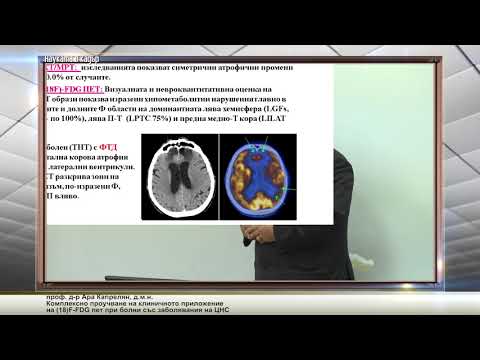 Видео: Комплексно проучване на клиничното приложение на (18)F-FDG пет при болни със заболявания на ЦНС
