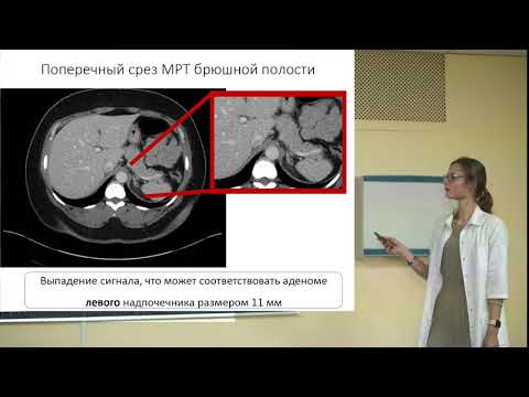 Видео: Первичный гиперальдостеронизм. Клинический случай