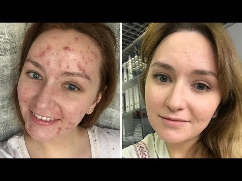 Видео: ДНЕВНИК ПОСТАКНЕ: ГОД СПУСТЯ