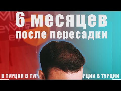 Видео: Пересадил волосы в Турции за 1200 $ | После 6 месяцев | Облысение | Серия 3