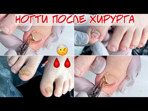 Видео: Ногти после удаления у хирурга 🤯 🩸🩸🩸 вросшие ногти 🥺