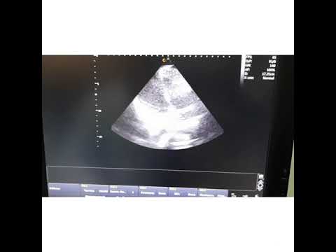 Видео: 📍Балалардағы жүрек пен магистралді қан тамырларының сәулелік диагностикасы. СРС👩🏼‍🏫