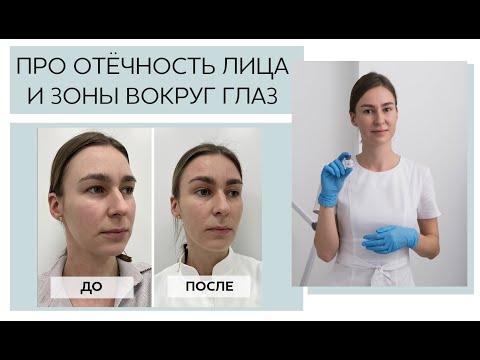 Видео: Про отечность лица и области вокруг глаз. Результаты ДО и ПОСЛЕ процедуры.