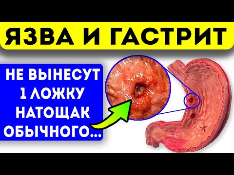 Видео: Подруга жаловалась на желудок, пока не... Гастрит и язва желудка народными средствами!