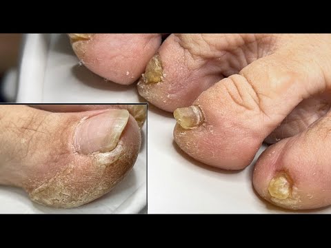 Видео: Срезаю, выковыриваю, зачищаю все лишнее/ Онихогрифозные ногти/Педикюр