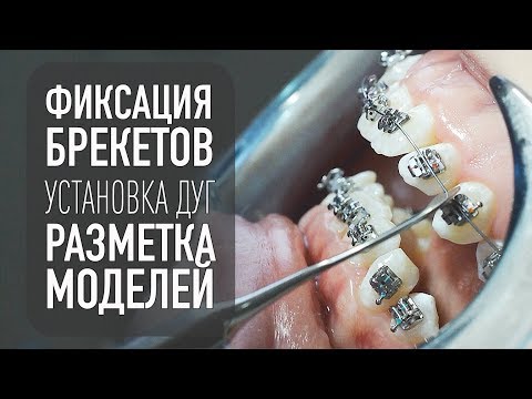 Видео: Брекеты– фиксация, установка дуг, разметка моделей | стоматология и ортодонтия самара влог