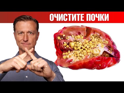 Видео: Очищение почек от оксалатов. Профилактика камней в почках ✅