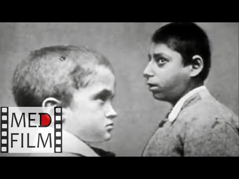 Видео: Как определить шизофрению у детей? © Schizophrenia in children - how to identify?