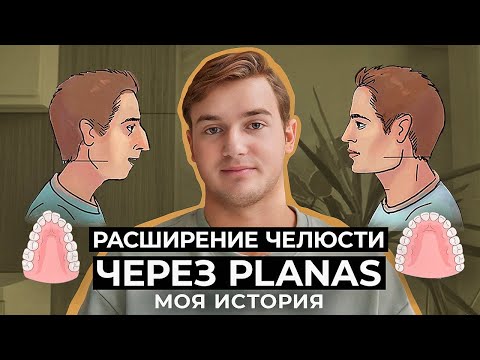 Видео: Расширение челюсти через ПЛАНАС. Почему я НЕ выбрал брекеты