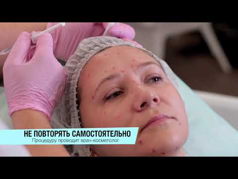 Видео: Ботулинотерапия препаратом ксеомин, в технике фулфейс
