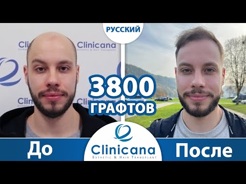 Видео: Пересадке Волос в Турции, Стамбуле | Clinicana отличный результат всего через 10 месяцев