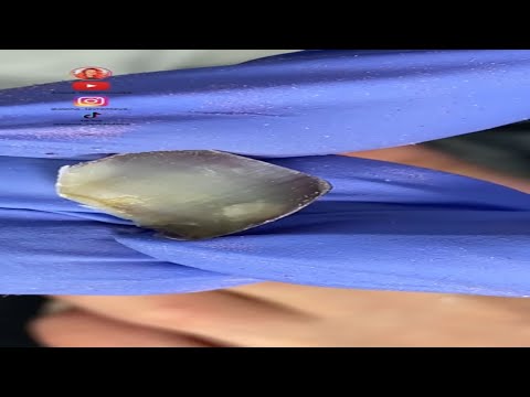 Видео: 💥Сильный ушиб большого пальца ноги😫Бо-бо у ногтя🙈 #онихолизис #nails #ногти #аленалаврентьева
