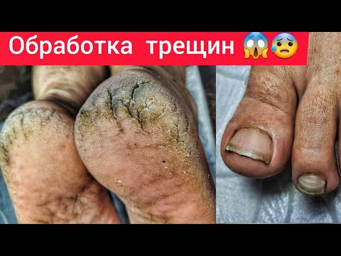 Видео: ПЕРВЫЙ РАЗ В ЖИЗНИ 🤯ГЛУБОКИЕ ТРЕЩИНЫ 😱СЛОЖНЫЙ ПЕДИКЮР 😰