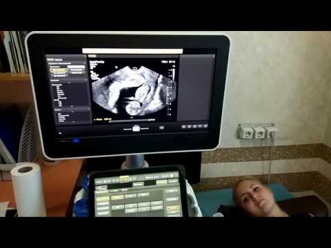 Видео: УЗИ на  11-й неделе беременности.Скрининг 11 недель