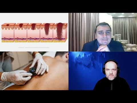 Видео: 1429. И.В. Самойленко: Обнаружение и лечение меланомы
